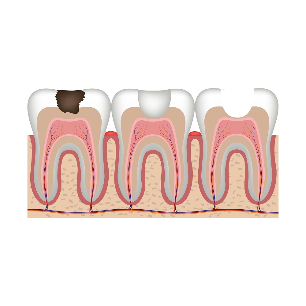 cavity treatment midland mi boss and rorvik dentistry